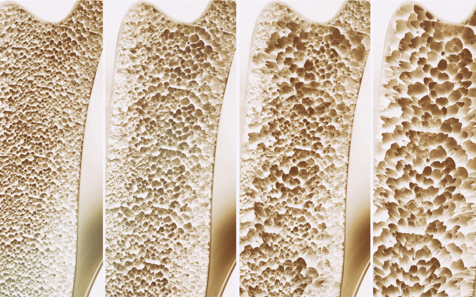 Bones showing osteoporosis advance